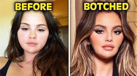 buccal fat removal celebrity|17 Celebrities Who Have Had Buccal Fat Removal